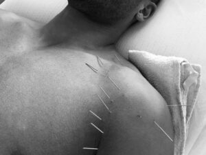 sportsskader dahl akupunktur hobro 2
